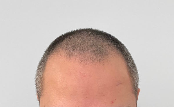 Hair TP Clinic | Hair Transplant | 411 34 Göteborg