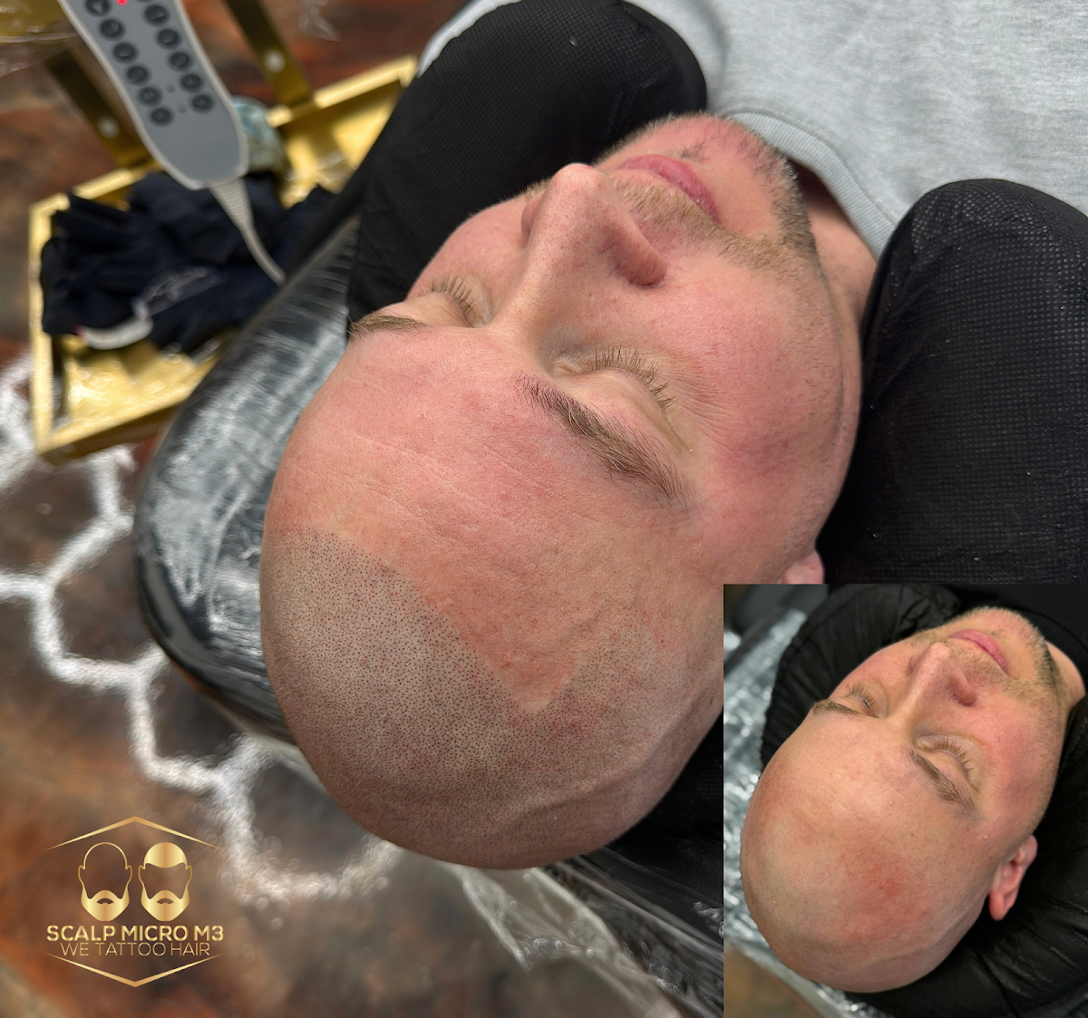 Scalp Micro M3 | Hair Transplant | Boise, ID