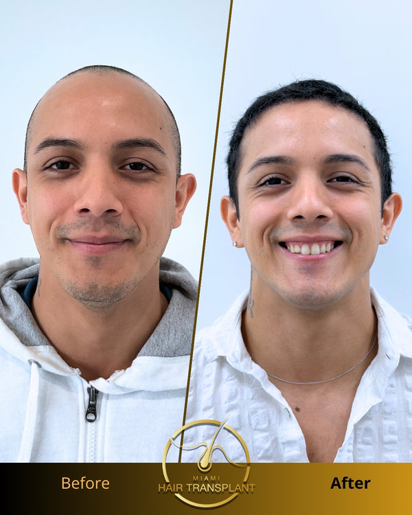 Miami Hair Transplant | Hair Transplant | Miami, MS
