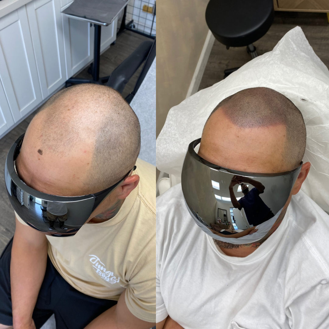 Supreme SMP | Hair Transplant | Aiea, HI