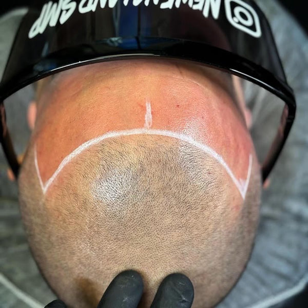 NewEngland.SMP | Hair Transplant | North Providence, RI