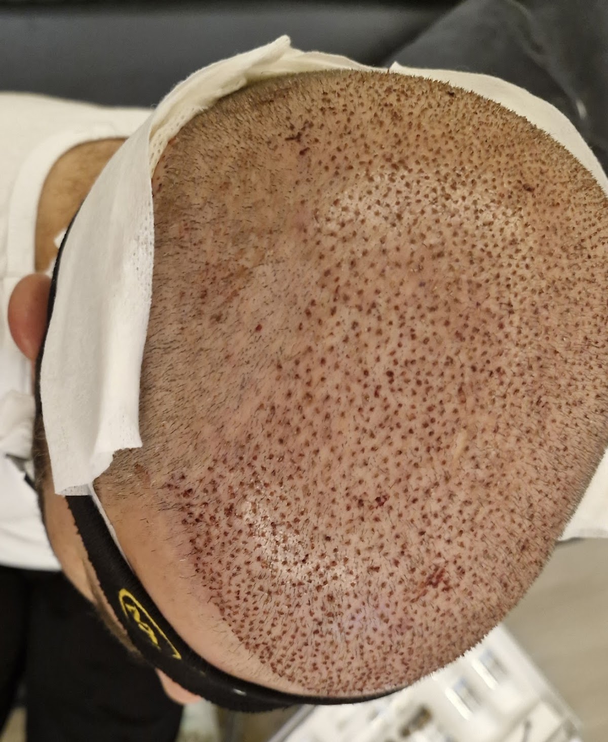 İzmir saç ekim merkezi maxhairclinic / maxhairizmir/saç ekim İzmir — Dr.Visor photo 3