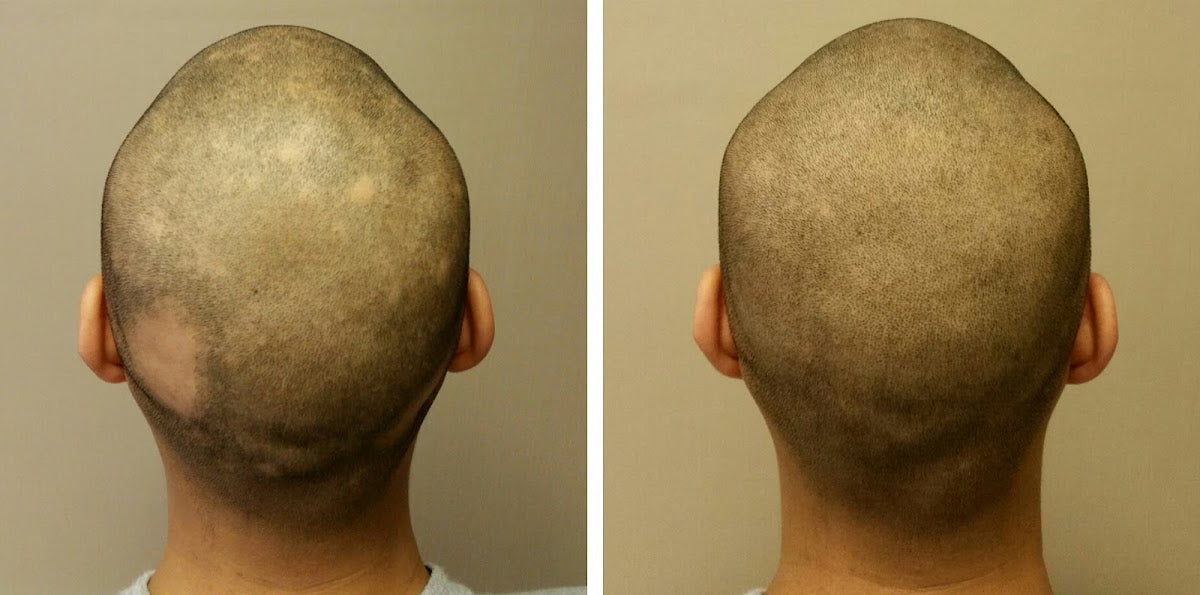Your Hair Clinic | Scalp Micro Pigmentation Nottingham - Hair Transplant clinic in Nottingham, United Kingdom