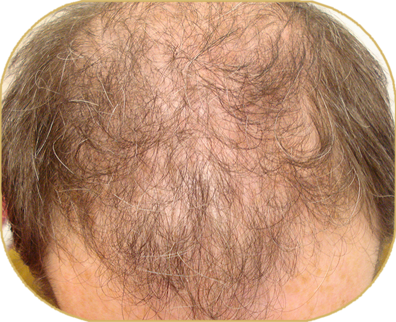 Hairmedic Newcastle - The Iain Sallis Trichology Clinic — photo 2