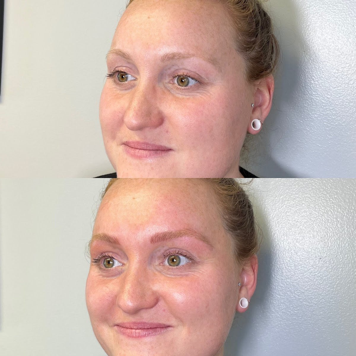Memento Micro | Hair Transplant | Essex Junction, VT