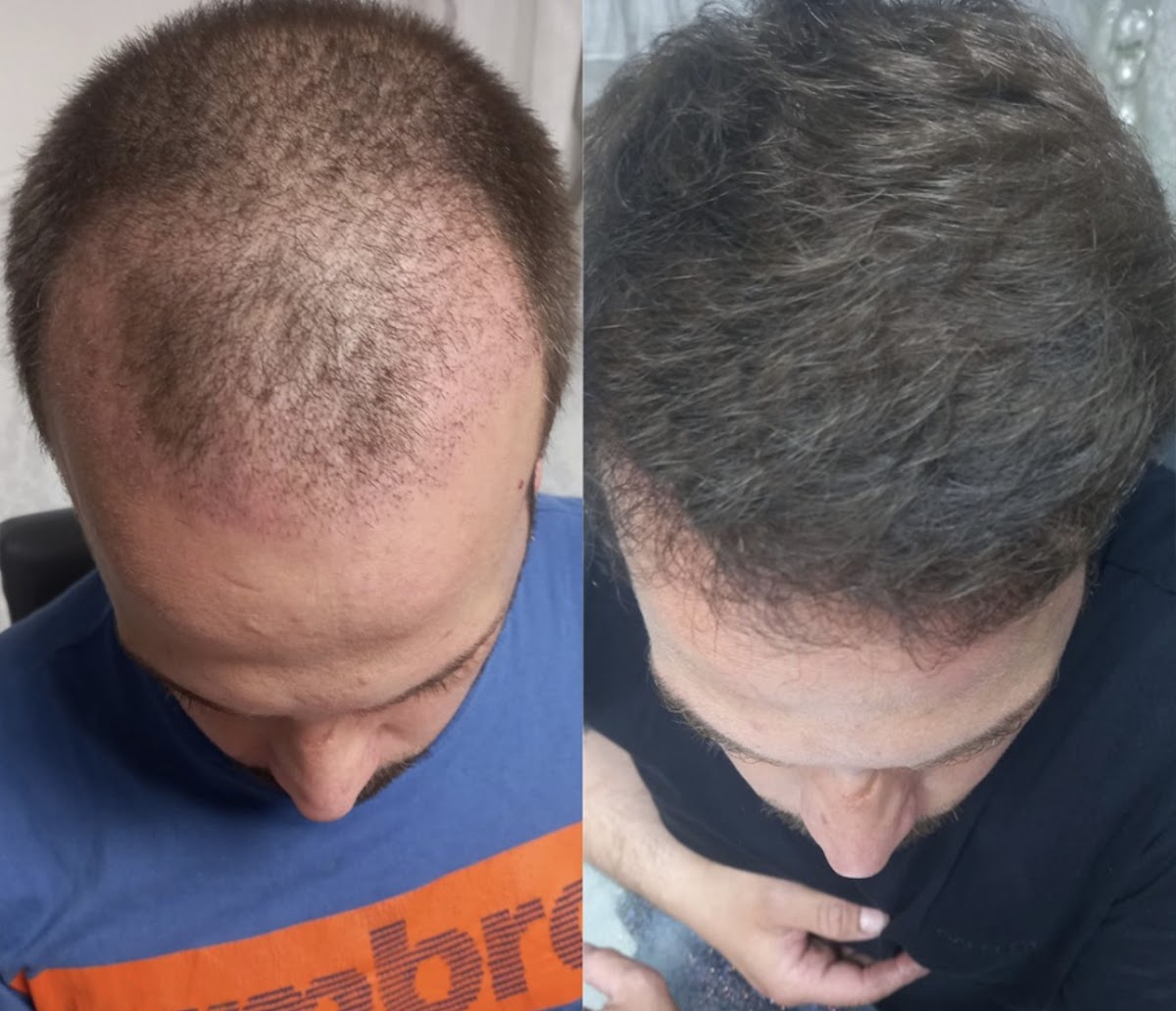 Best hair transplant clinic Manchester — photo 4