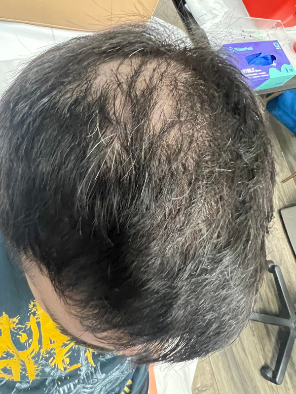 Bionetics Health | Hair Transplant | Las Vegas, NV