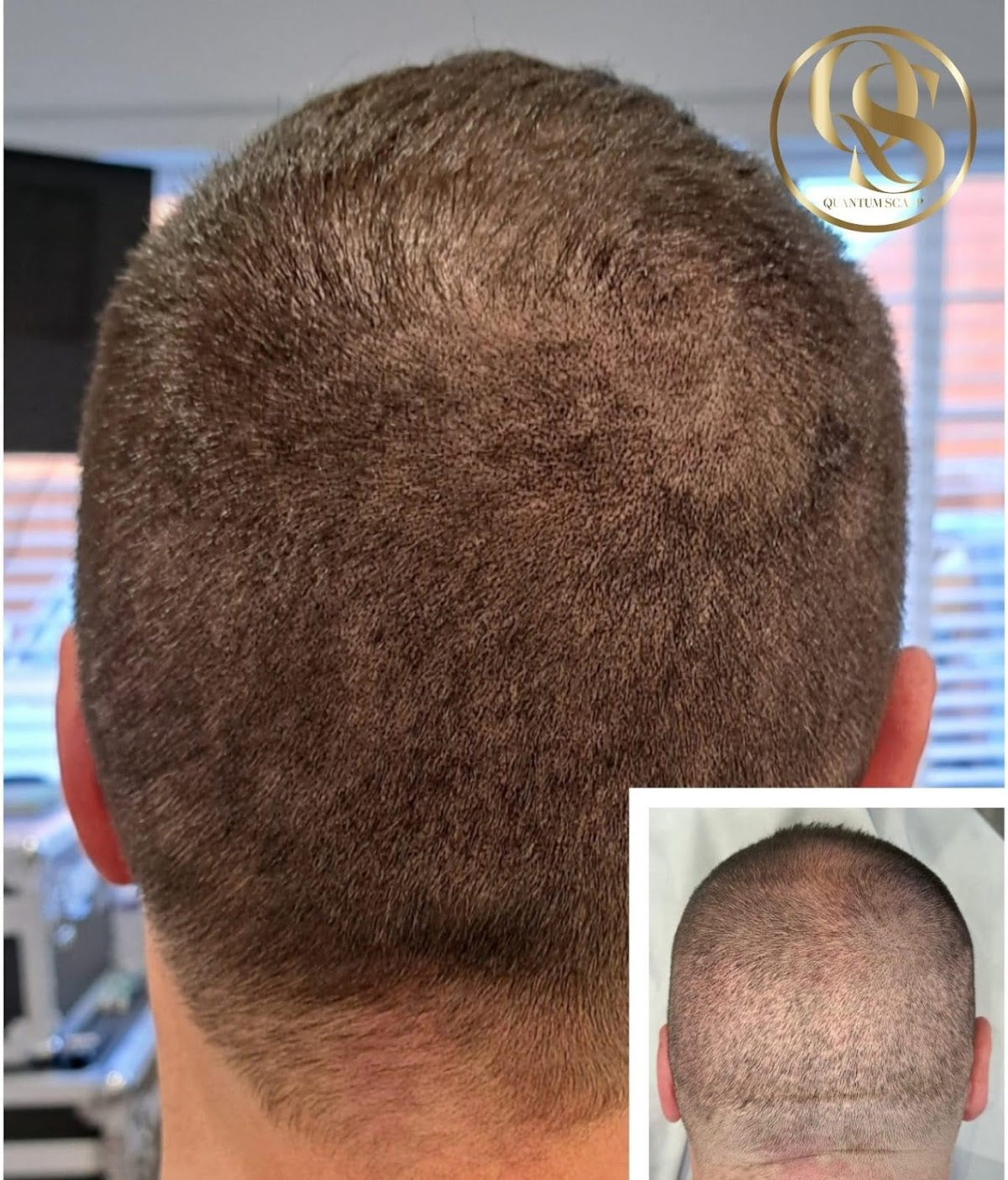 Quantum Laser and Scalp Micropigmentation (SMP) — photo 2