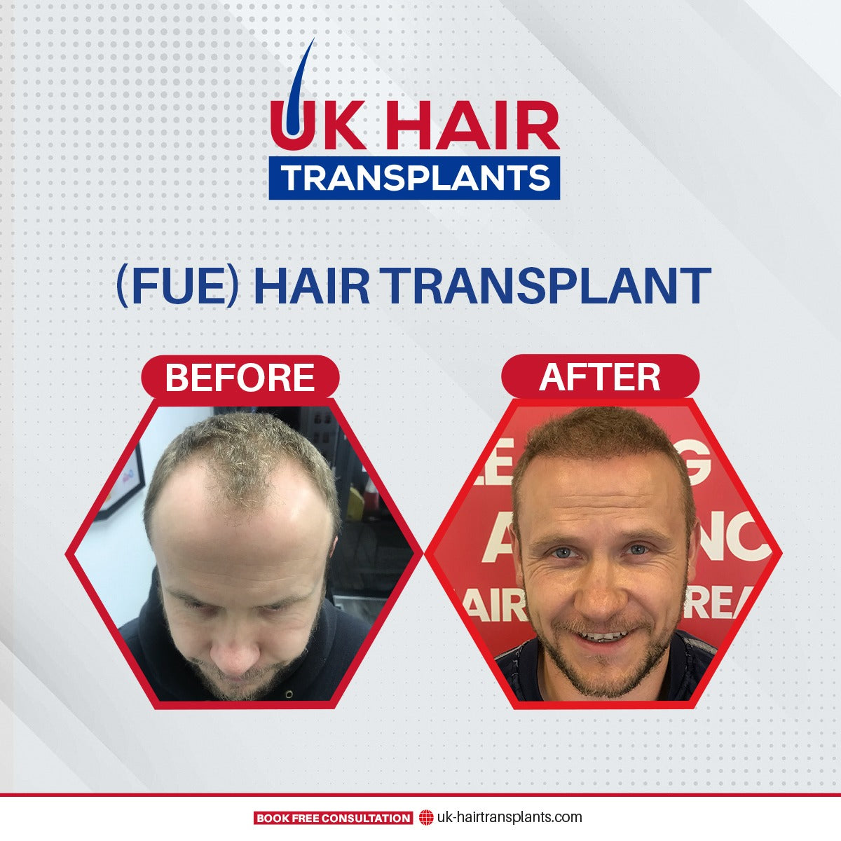 UK Hair Transplants UKHT Birmingham — photo 4