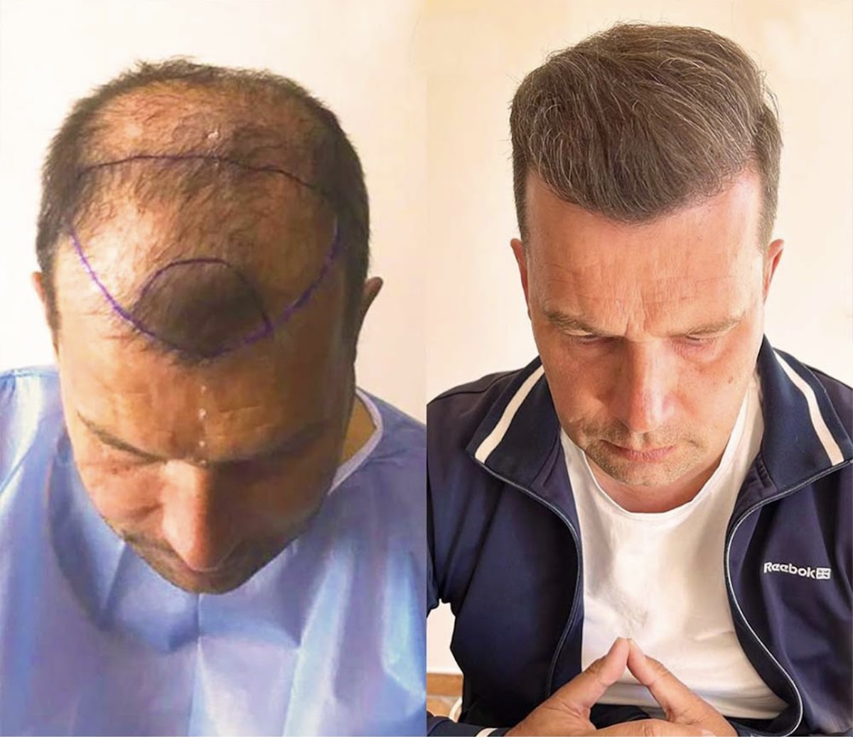 Best hair transplant clinic Manchester — photo 3