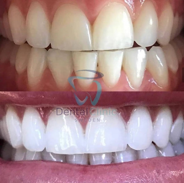 Dental Clinic Sweden - Tandblekning Stockholm | Dental | 114 30 Stockholm