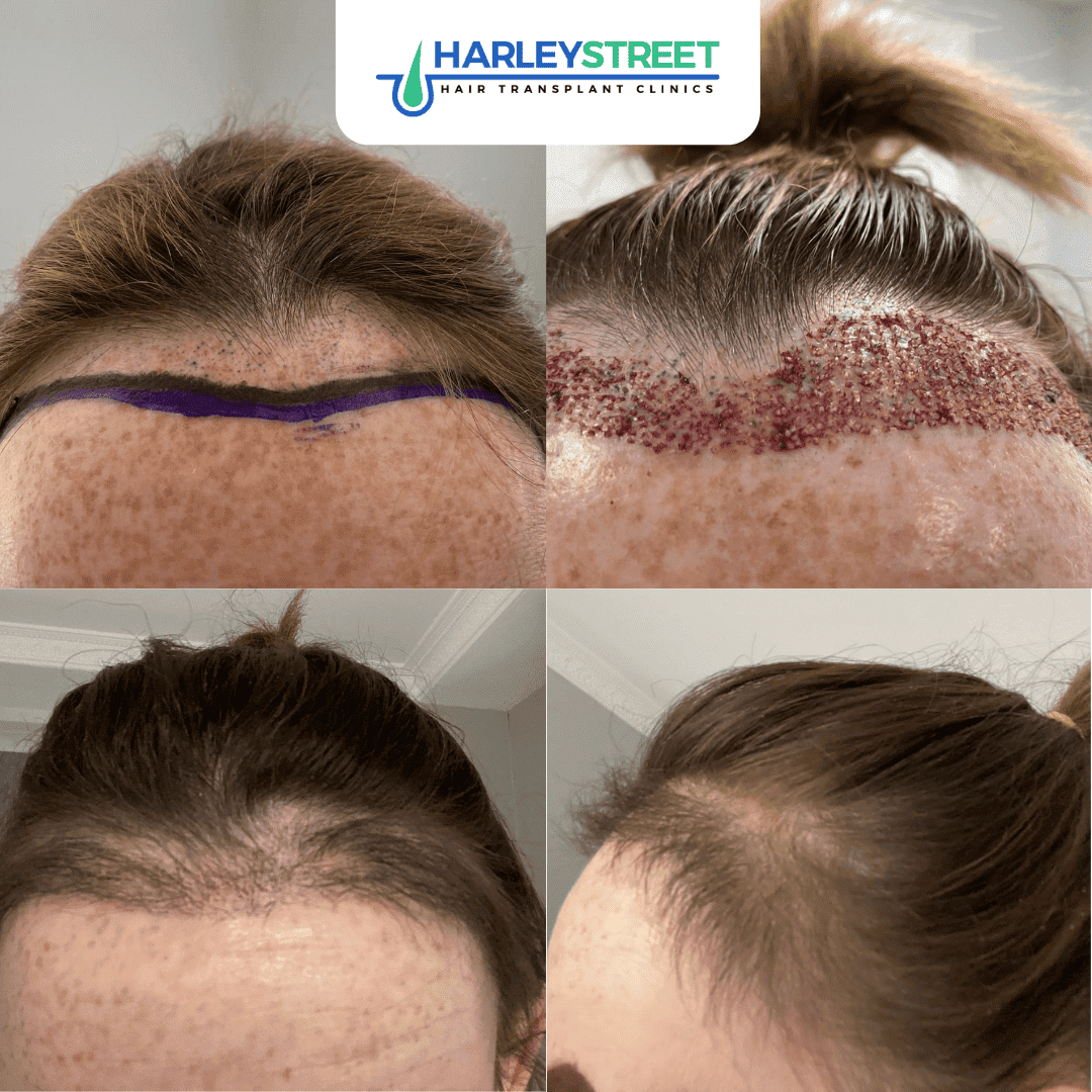 Hair Transplant Belfast — photo 4