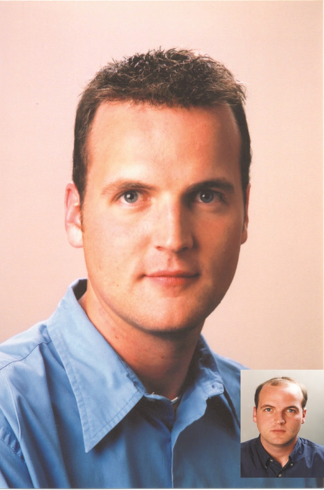 Apollo Hair Systems | Hair Transplant | Huntsville, AL