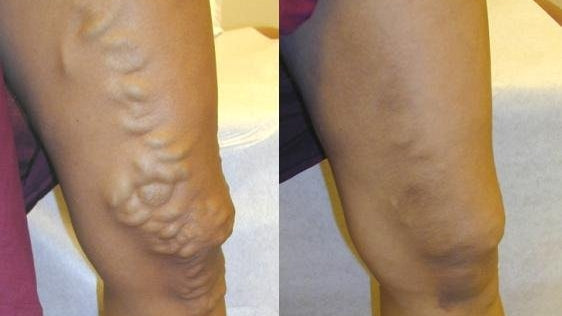 Aesthetic Laser and Vein Center | Laser Varicose Vein treatment in | Aesthetic Surgery | Glenn Dale, MD