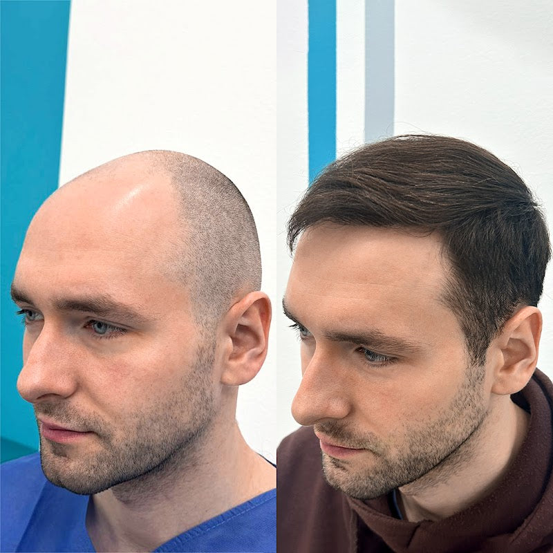 FullFace Clinic | Hair Transplant | 00-667 Warszawa