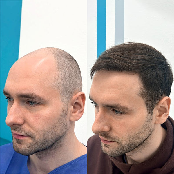 FullFace Clinic | Hair Transplant | 00-667 Warszawa