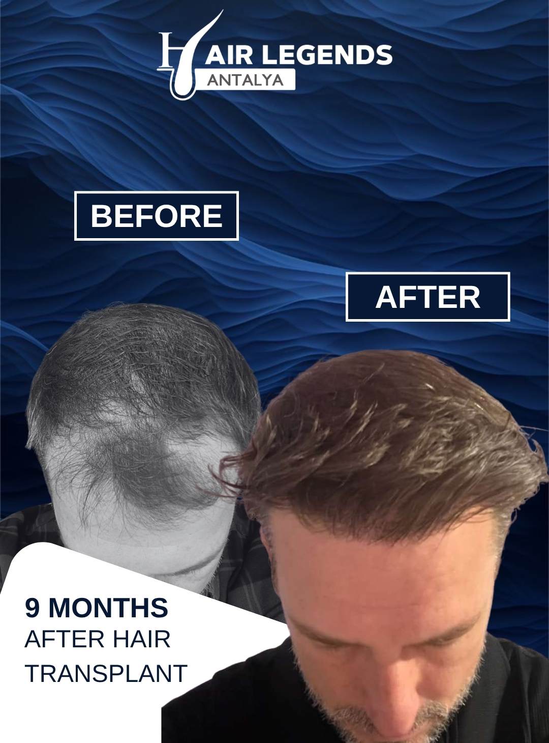 Hair Legends | Hair Transplant Antalya — Dr.Visor photo 5