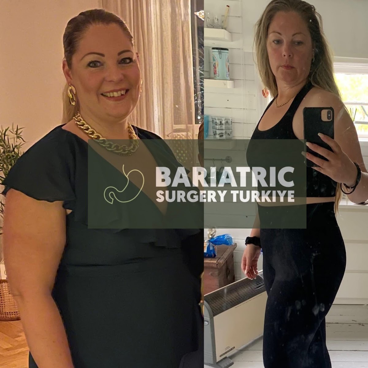 Bariatric Surgery Turkey — Dr.Visor photo 4