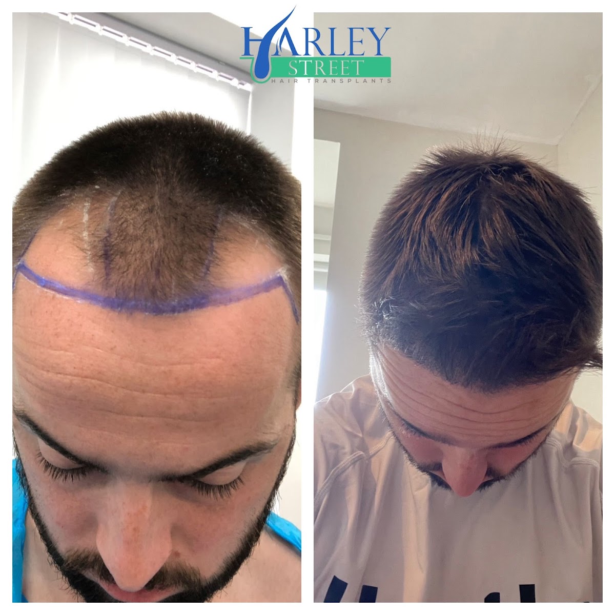 Edinburgh Hair Transplant Clinics — Dr.Visor photo 3