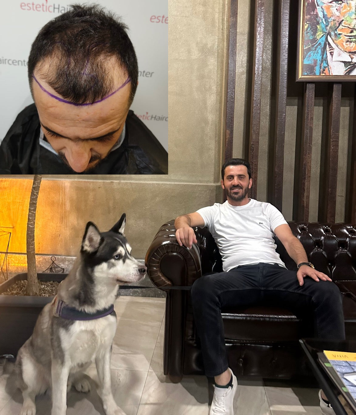 Estetichaircenter Saç Ekimi Saç Simülasyonu Bursa — Dr.Visor photo 3