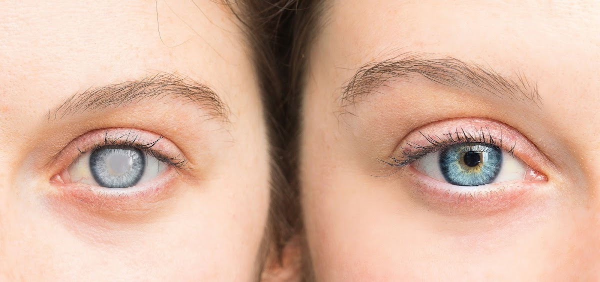 Lasik İstanbul - Augen Lasern Türkei | Lasik Eye Surgery Turkey | Cataract Surgery | Relex SMILE | Femto Laser — Dr.Visor photo 4