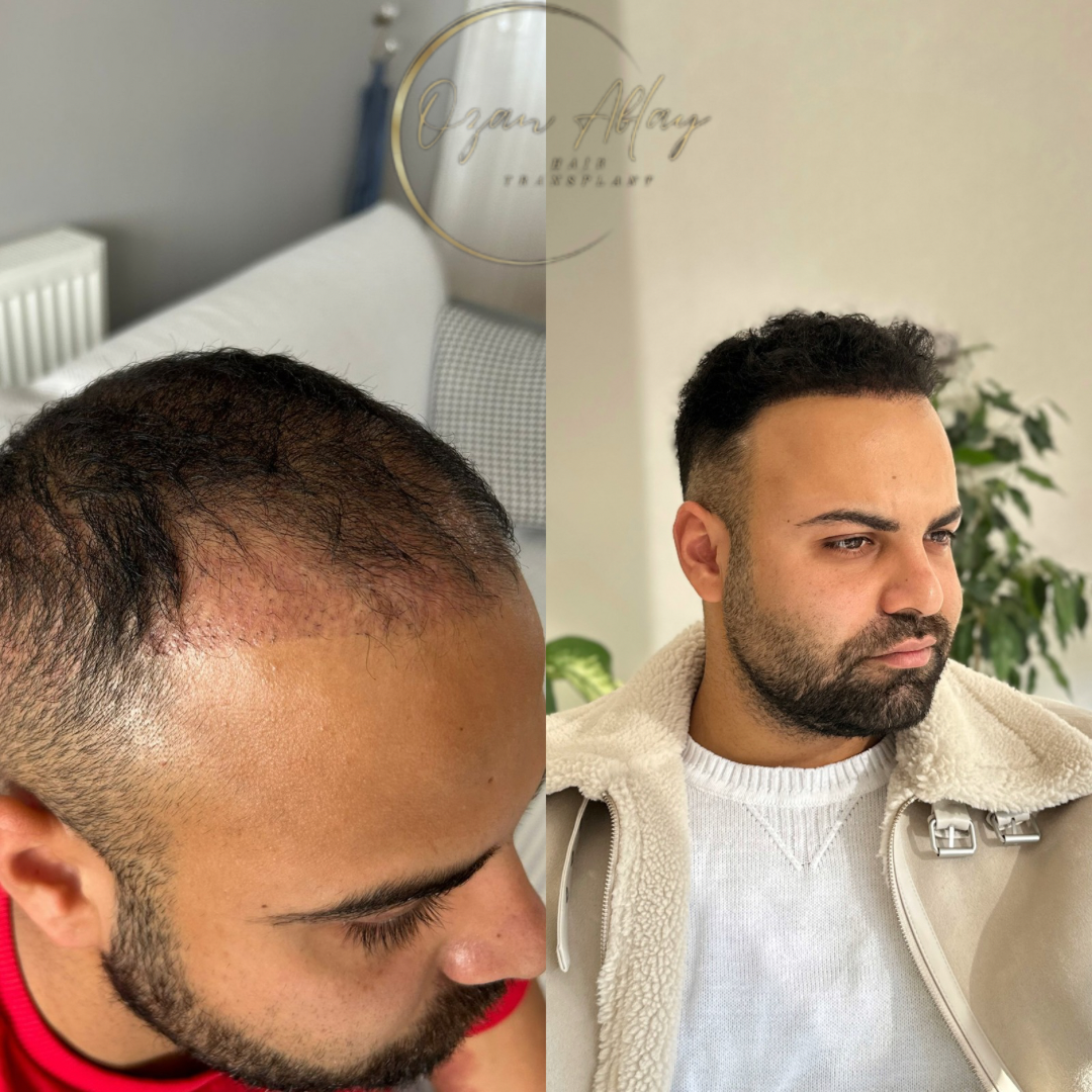 Ozan Ablay Hair Transplant — Dr.Visor photo 5