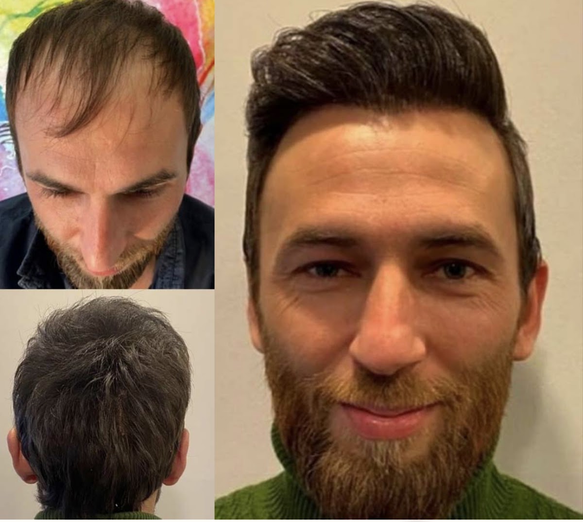 Best hair transplant clinic Manchester — Dr.Visor photo 5