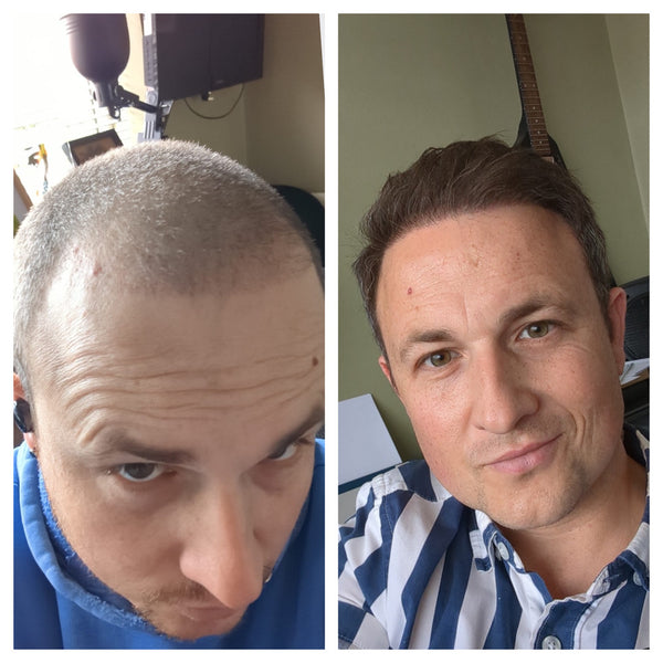 Edinburgh Hair Transplant Clinics
