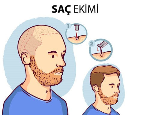 Antalya Hair Transplant in Turkey — Dr.Visor photo 4