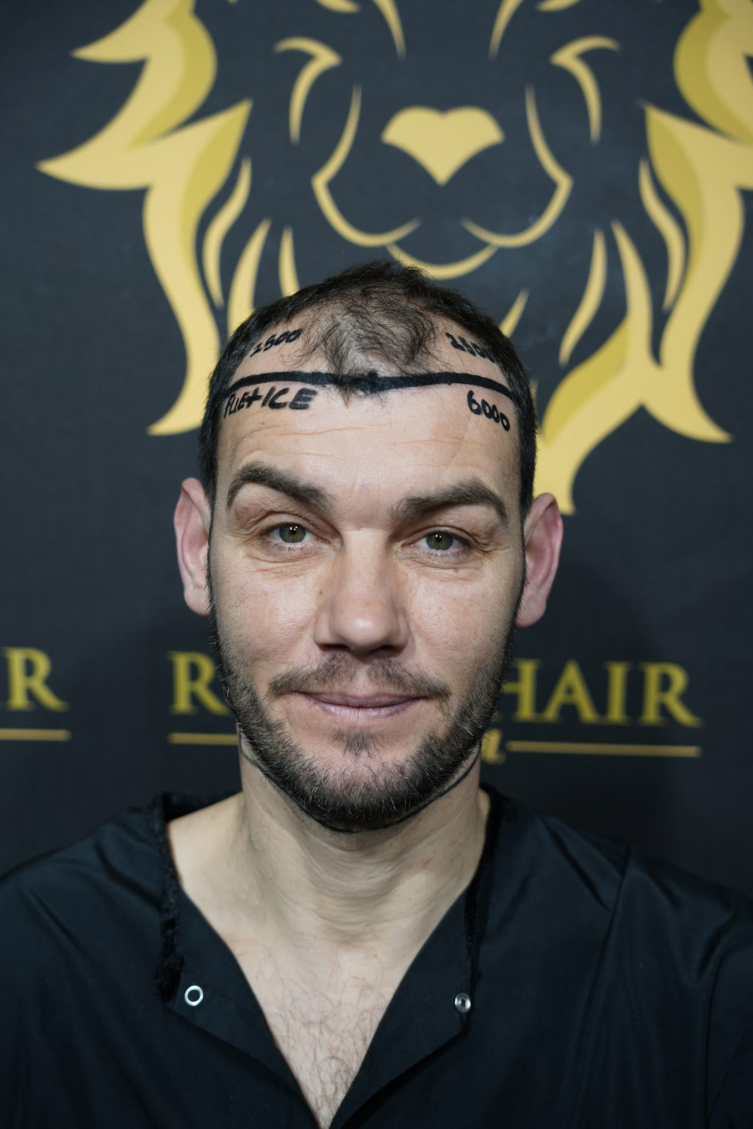 Royal Hair Istanbul | Hair Transplant Turkey — Dr.Visor photo 4