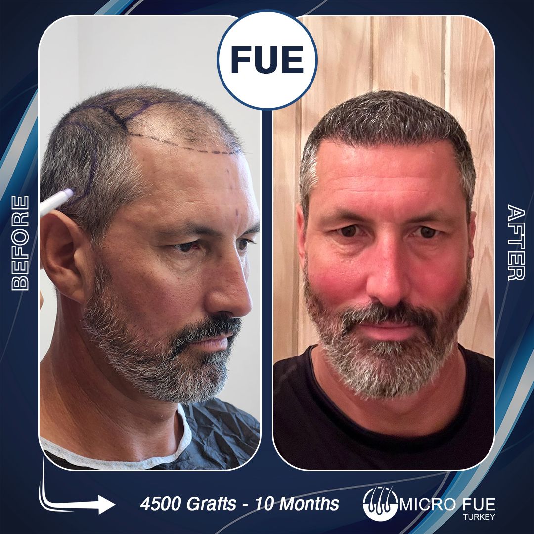 Hair Transplant Taksim | TESLA TRAVEL ISTANBUL — Dr.Visor photo 5