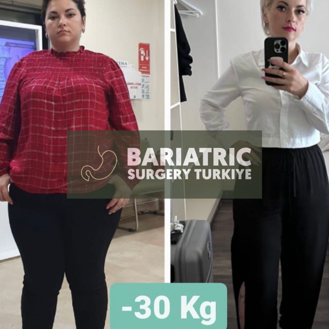 Bariatric Surgery Turkey — Dr.Visor photo 2