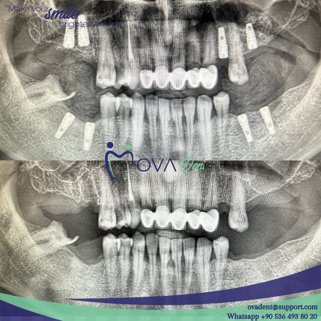 Alanya OvaDent Dental Clinic — Dr.Visor photo 5