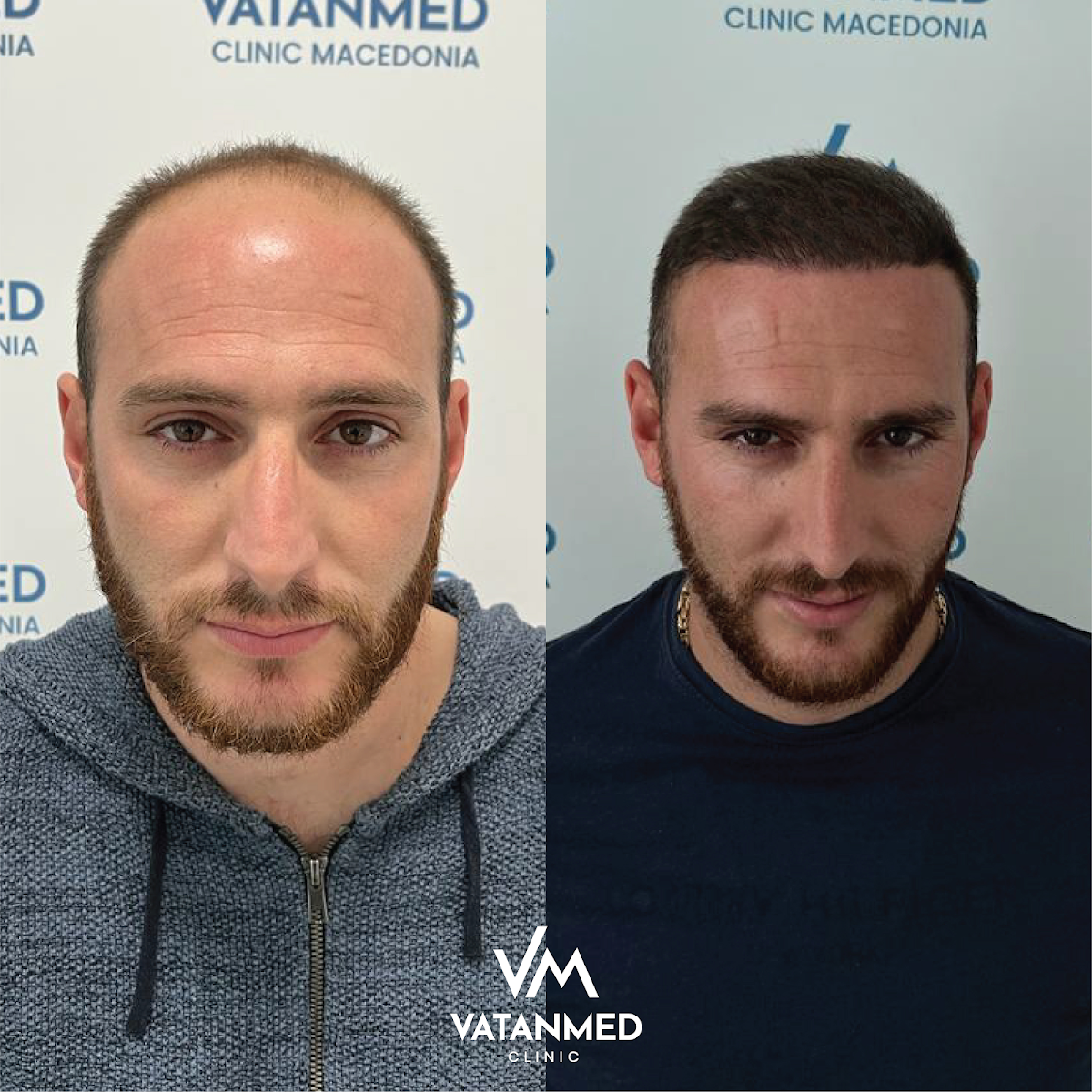 Vatanmed Clinic Montenegro - Hair Transplant clinic in Podgorica, Montenegro