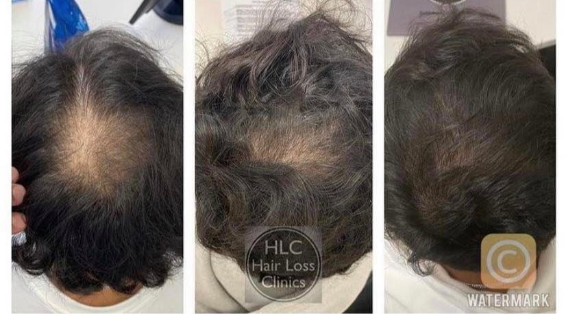 Birmingham Hair Clinic — Dr.Visor photo 4