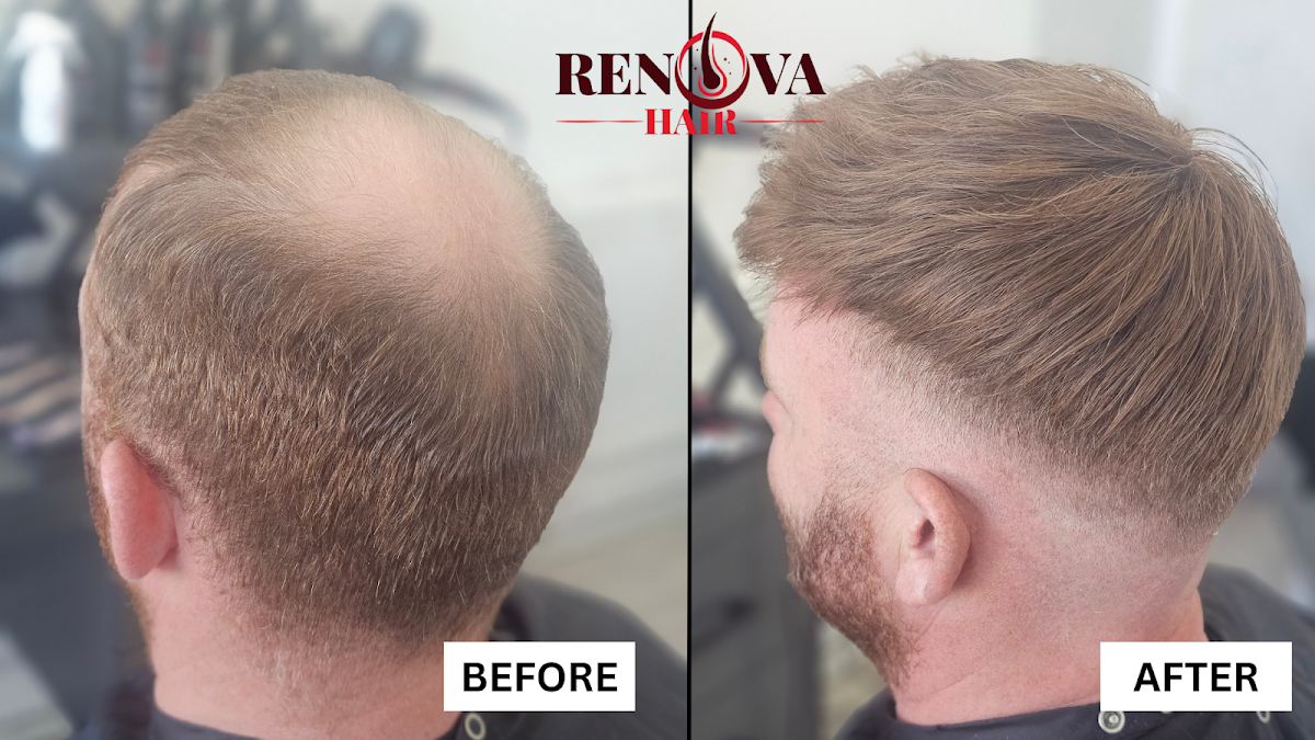 Renova Hair Trichology — Dr.Visor