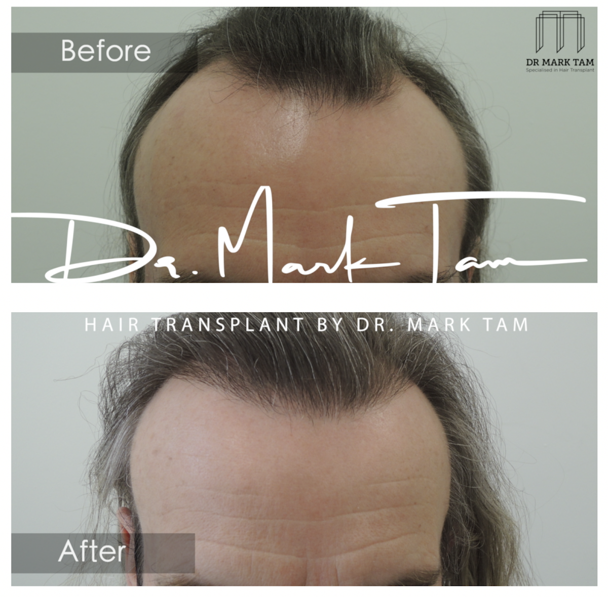 Hair Transplant by Dr Mark Tam — Dr.Visor