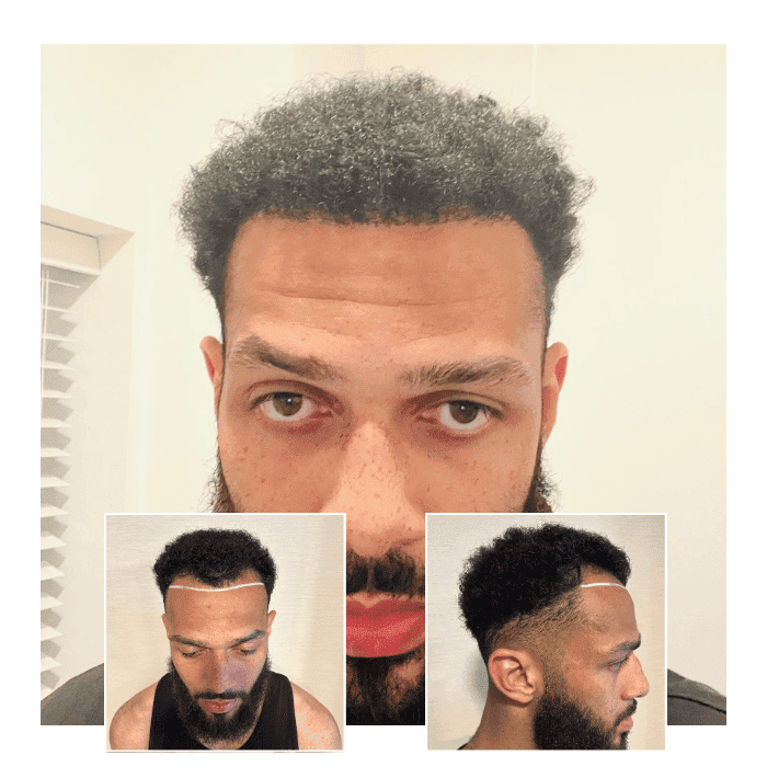 Capital Hair Restoration - Hair Transplant — Dr.Visor photo 5
