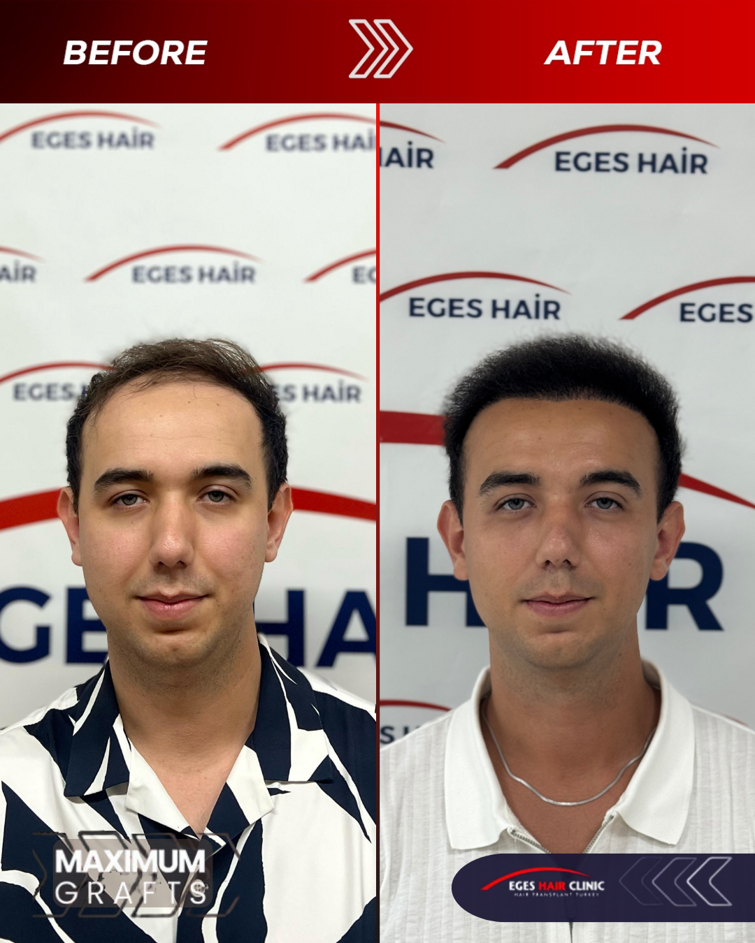 Bodrum Saç Ekim Merkezi | Bodrum Hair Transplant — Dr.Visor photo 3