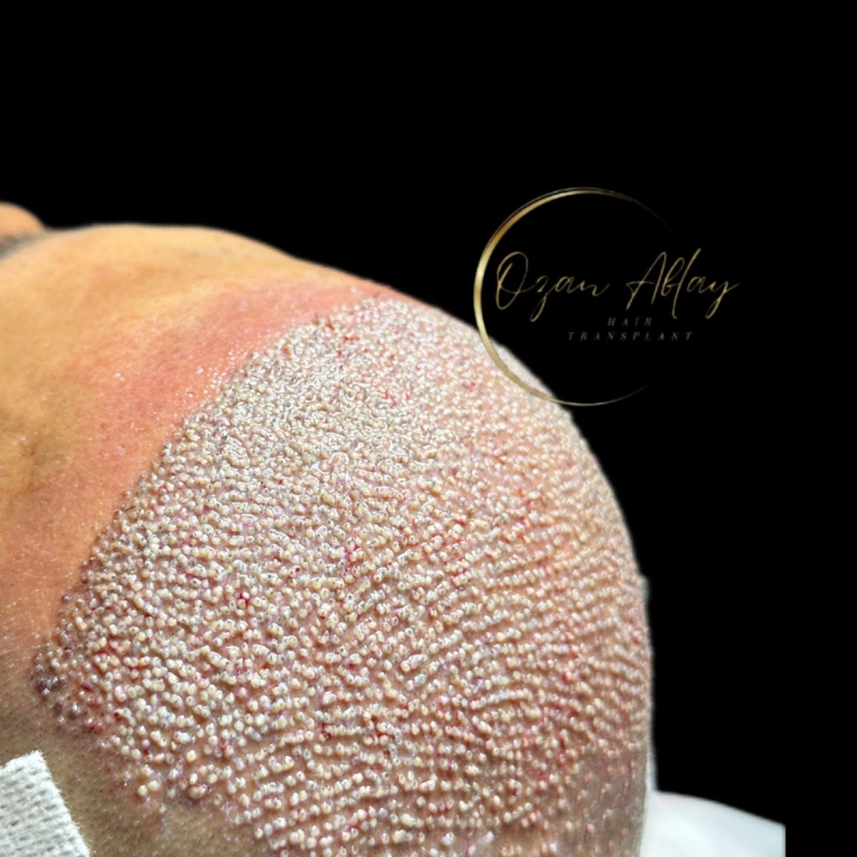 Ozan Ablay Hair Transplant — Dr.Visor photo 4