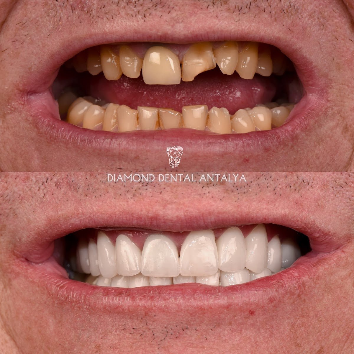 Diamond Dental Antalya | Diş Hekimi - Diş Polikliniği | Implant, Veneer, Crowns Dentist — Dr.Visor photo 3