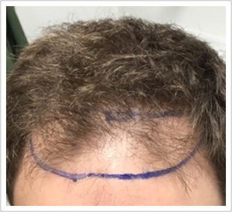 UK Hair Transplant Clinics Edinburgh — Dr.Visor photo 5
