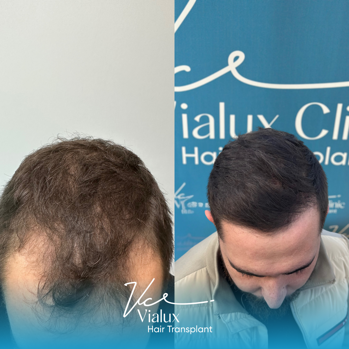 Vialux Hair Transplant | Ankara Saç Ekimi — Dr.Visor photo 4