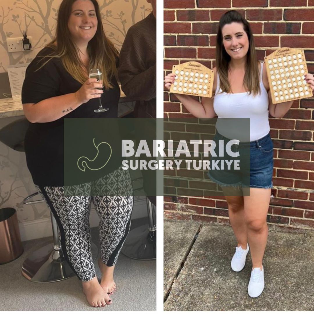 Bariatric Surgery Turkey — Dr.Visor photo 3