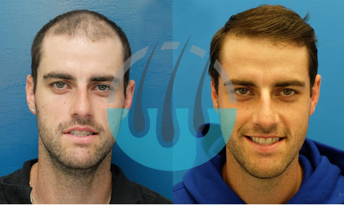 Hair Transplant Clinic Turkey — Dr.Visor photo 5