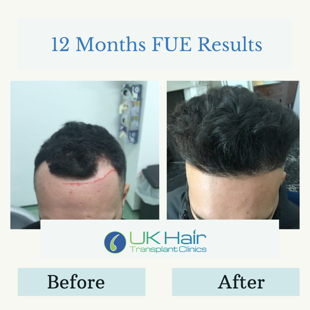 UK Hair Transplant Clinics Manchester — Dr.Visor photo 5