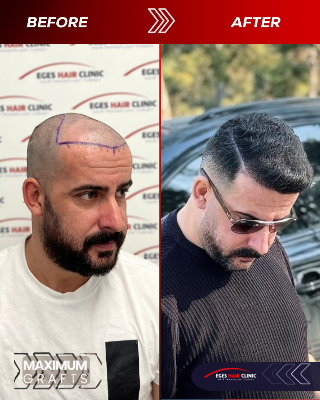 Bodrum Saç Ekim Merkezi | Bodrum Hair Transplant — Dr.Visor photo 4