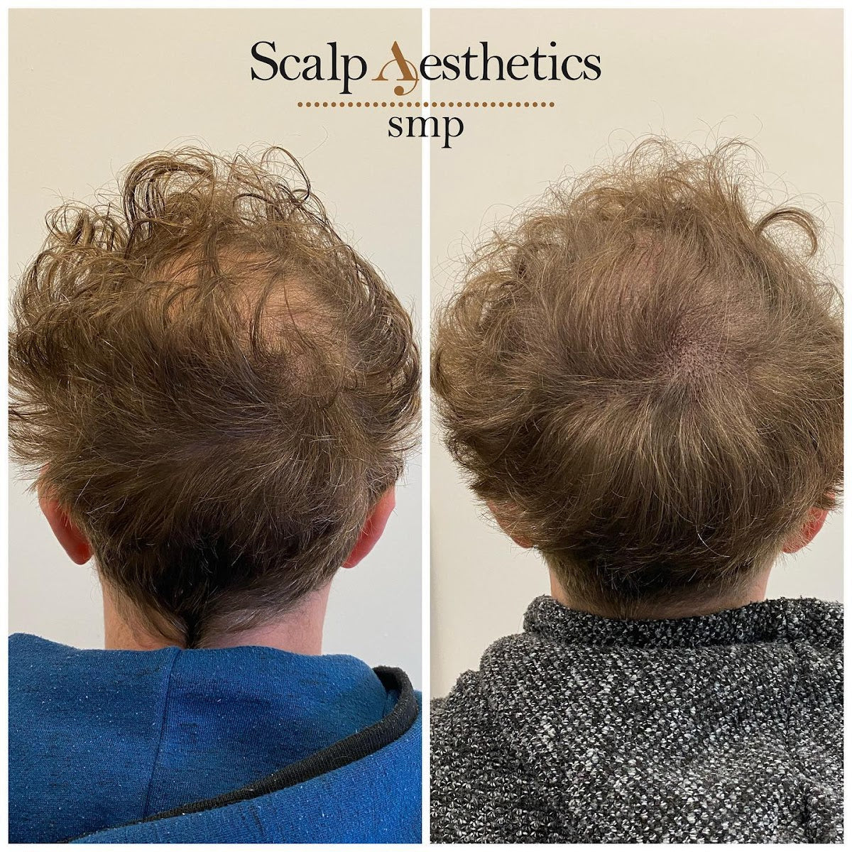 Scalp Aesthetics smp — Dr.Visor photo 2