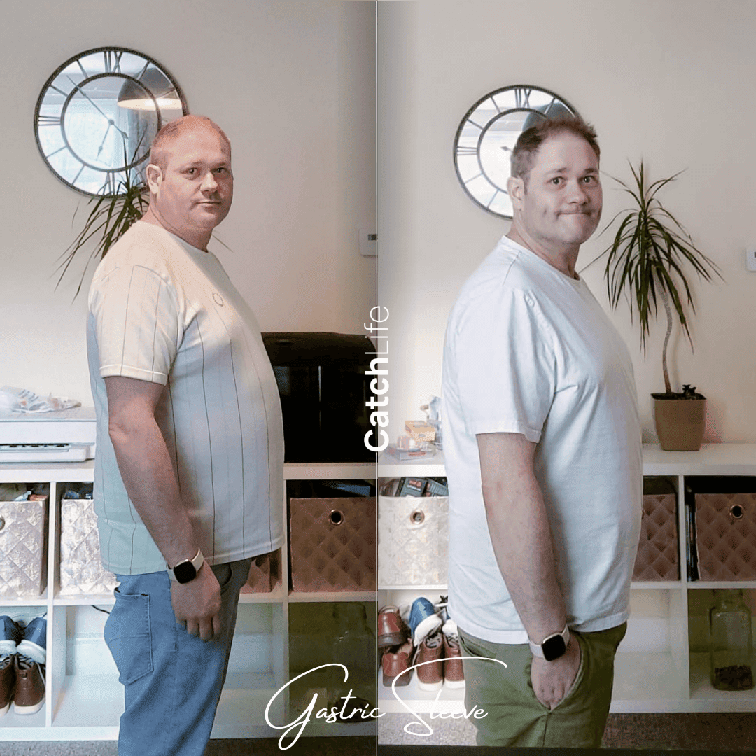 CatchLife Obesity | Gastric Sleeve Antalya — Dr.Visor photo 5