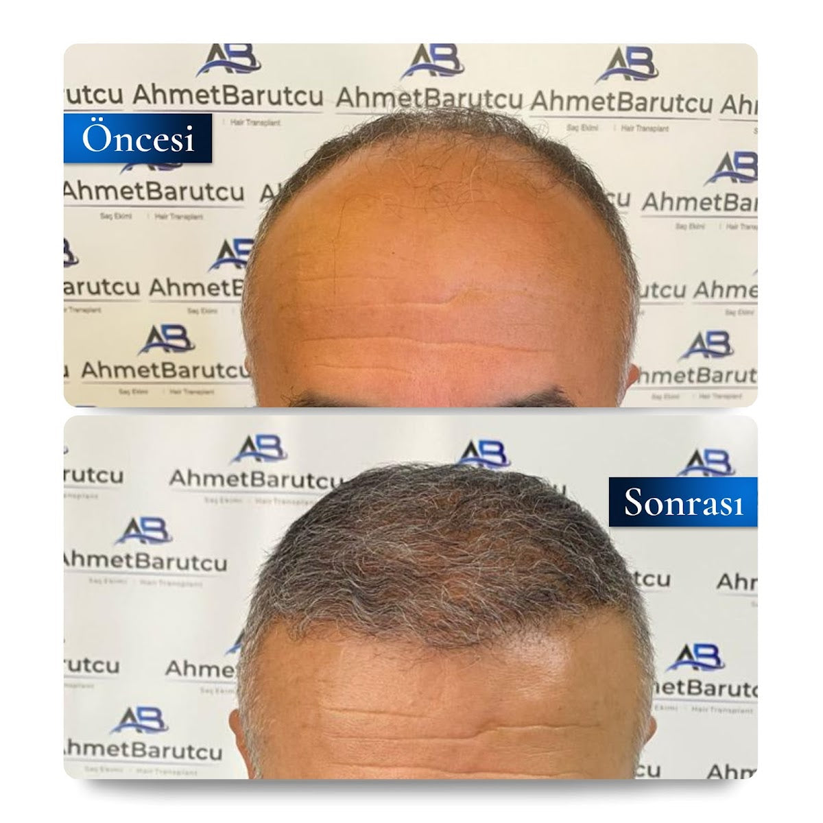 Ahmet Barutcu Saç Ekimi / Hair Transplant — Dr.Visor photo 4